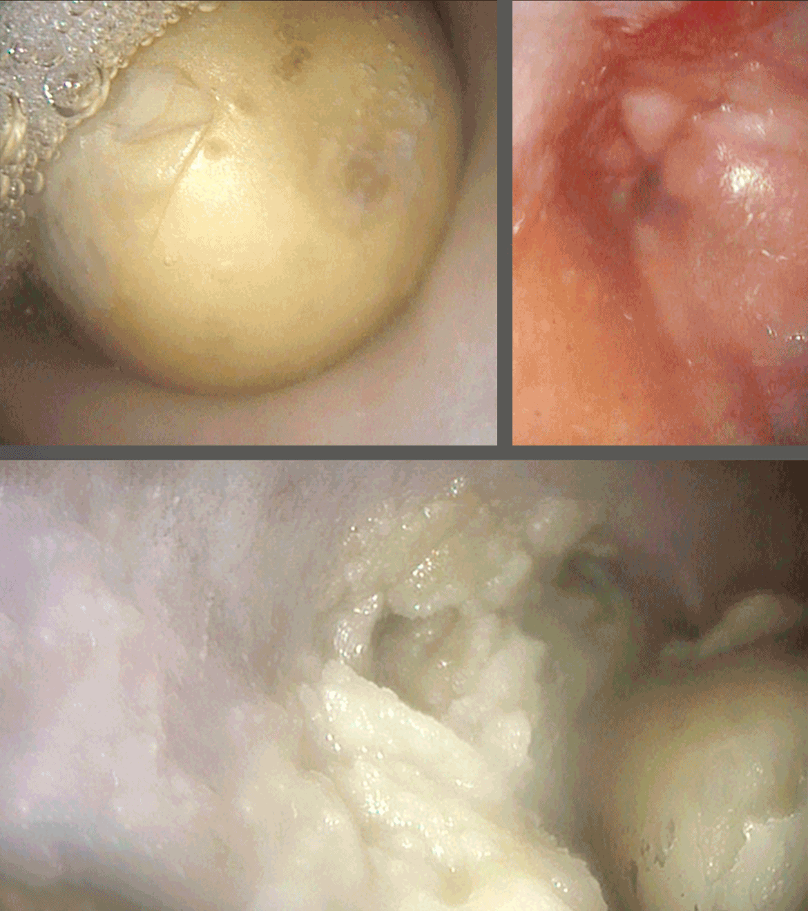 Verschluckte Kartoffel steckt in der Speiseröhre 3 verschiedene Bilder zeigen den Fremdkörper der in der Speiseröhre feststeckt.
